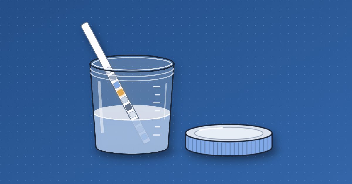 A clear specimen cup of pale blue liquid with a urinalysis dipstick leaning in it, one of its square test pads amber, and the screw lid set beside it.